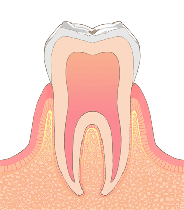 C0の虫歯の画像です