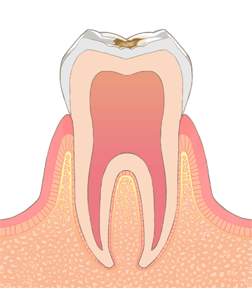 C1の虫歯の画像です