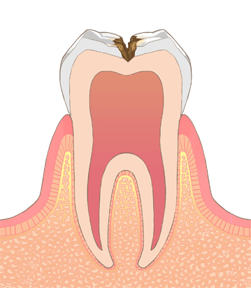 C2の虫歯の画像です