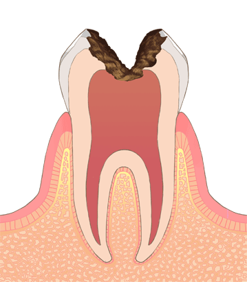 C3の虫歯の画像です